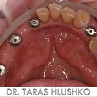 Protezuvannia Na Zubakh Ta Implantakh V6 I5