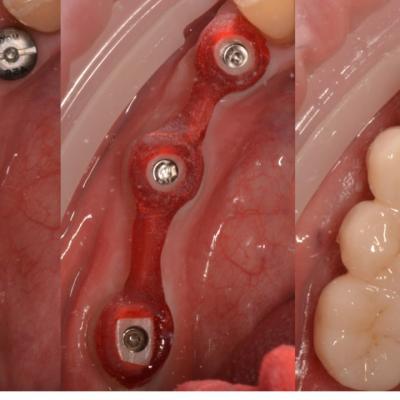 Protezuvannia Na Zubakh Ta Implantakh V6 I7