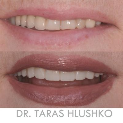 Protezuvannia Na Zubakh V9 I1