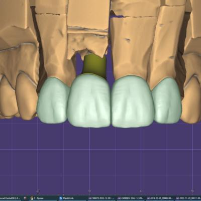 Protezuvannia Na Zubakh Ta Implantakh V7 I2