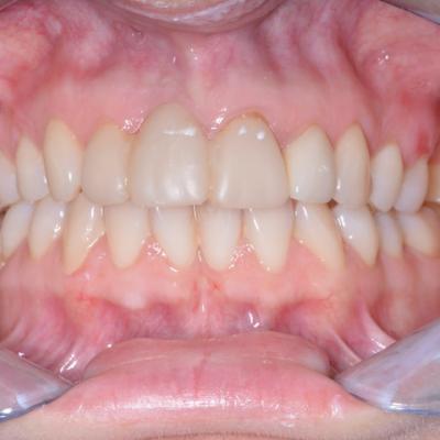 Protezuvannia Na Zubakh Ta Implantakh V7 I3