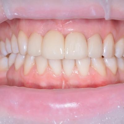 Protezuvannia Na Zubakh Ta Implantakh V7 I4