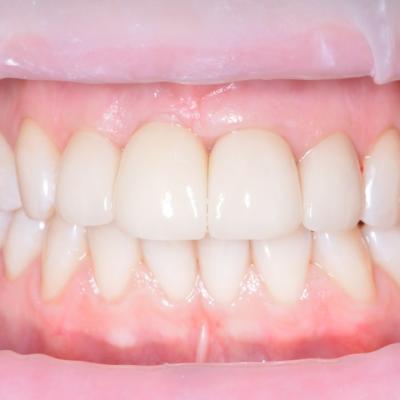 Protezuvannia Na Zubakh Ta Implantakh V7 I5