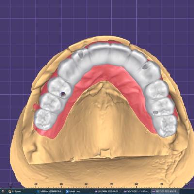 Protezuvannia Na Implantakh V9 I1
