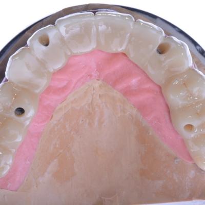 Protezuvannia Na Implantakh V9 I3