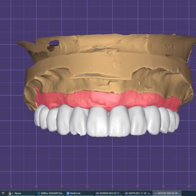 Protezuvannia Na Implantakh V9 I4