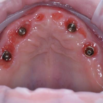 Protezuvannia Na Implantakh V9 I5