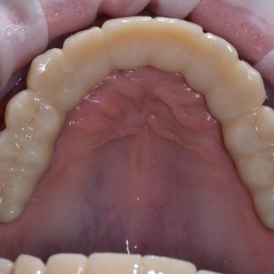 Protezuvannia Na Implantakh V9 I6