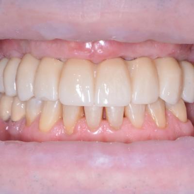 Protezuvannia Na Implantakh V9 I7