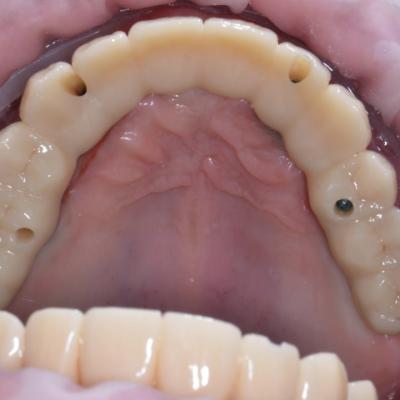 Protezuvannia Na Implantakh V9 I8