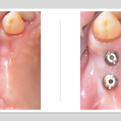 Protezuvannia Na Implantakh V10 I1