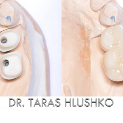 Protezuvannia Na Implantakh V10 I2