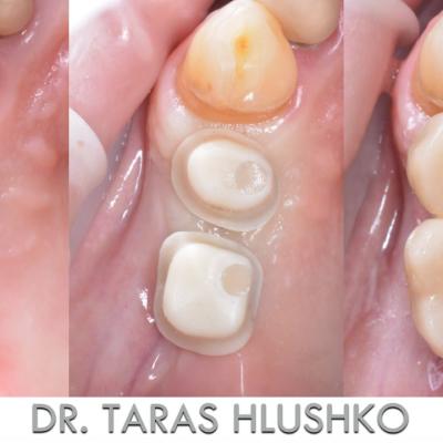 Protezuvannia Na Implantakh V10 I3