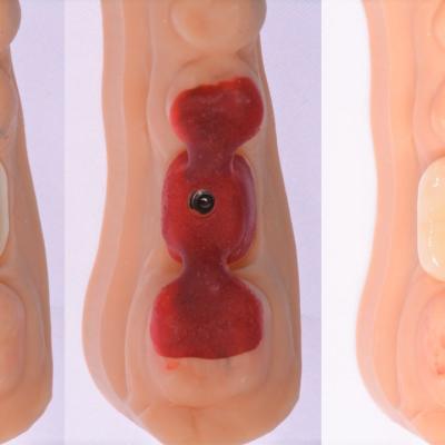 Protezuvannia Na Implantakh V11 I1