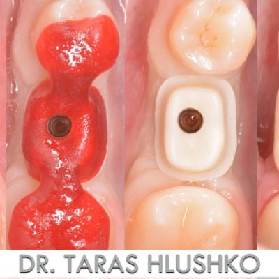 Protezuvannia Na Implantakh V11 I2