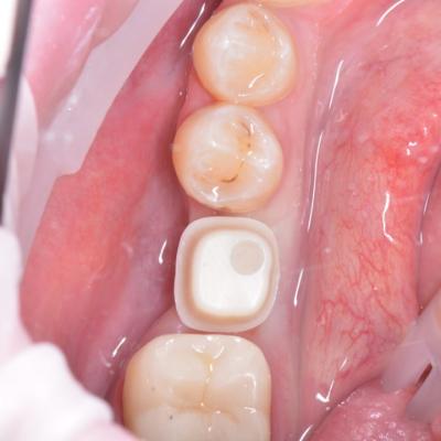 Protezuvannia Na Implantakh V12 I1