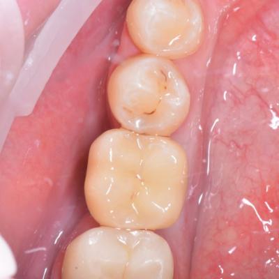 Protezuvannia Na Implantakh V12 I2