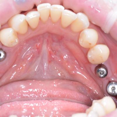 Protezuvannia Na Implantakh V12 I1