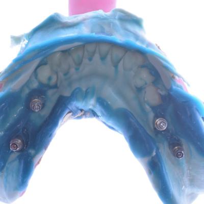 Protezuvannia Na Implantakh V12 I2
