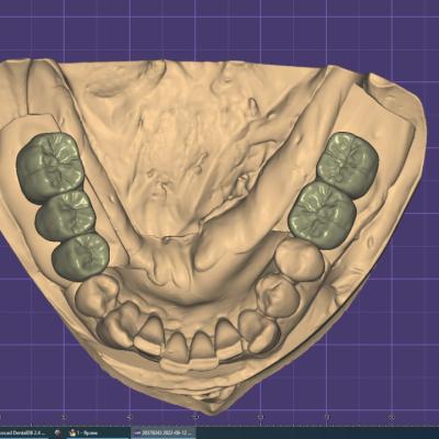 Protezuvannia Na Implantakh V12 I4