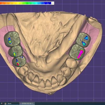 Protezuvannia Na Implantakh V12 I5