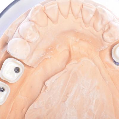 Protezuvannia Na Implantakh V12 I6