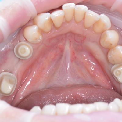 Protezuvannia Na Implantakh V12 I9