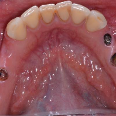 Protezuvannia Na Implantakh V001 001