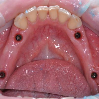 Protezuvannia Na Implantakh V001 002