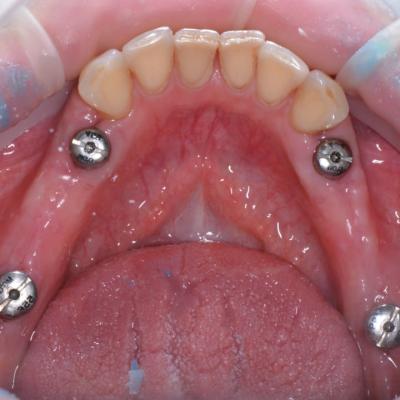 Protezuvannia Na Implantakh V001 003