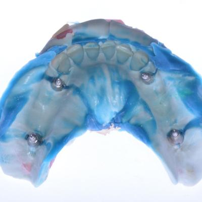 Protezuvannia Na Implantakh V001 004