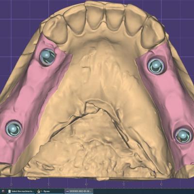 Protezuvannia Na Implantakh V001 005