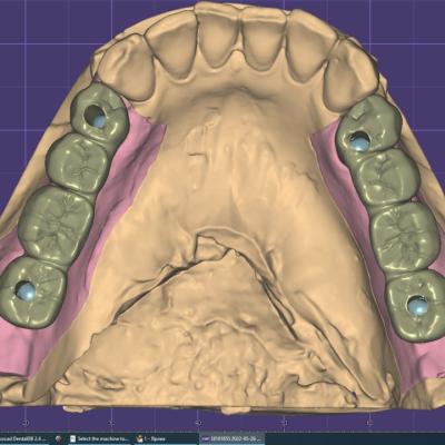 Protezuvannia Na Implantakh V001 006