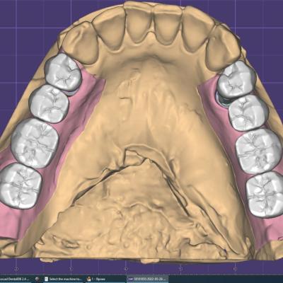 Protezuvannia Na Implantakh V001 007