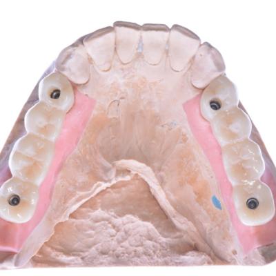 Protezuvannia Na Implantakh V001 008