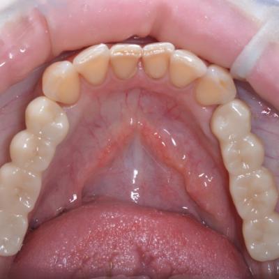 Protezuvannia Na Implantakh V001 009