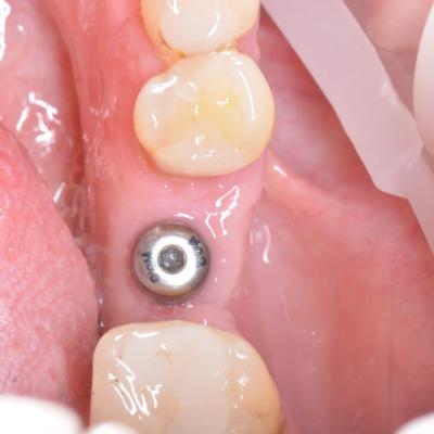 Protezuvannia Na Implantakh V14 I2