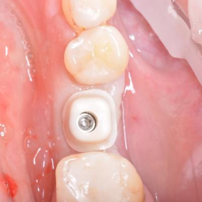 Protezuvannia Na Implantakh V14 I3