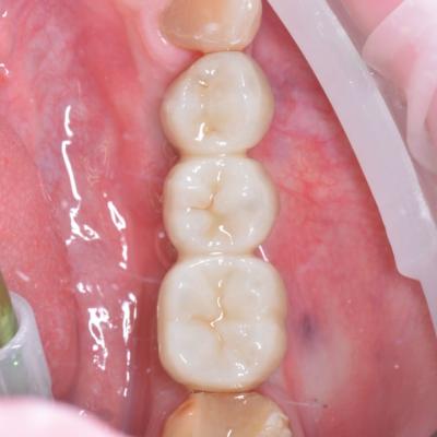 Protezuvannia Na Implantakh V15 I6