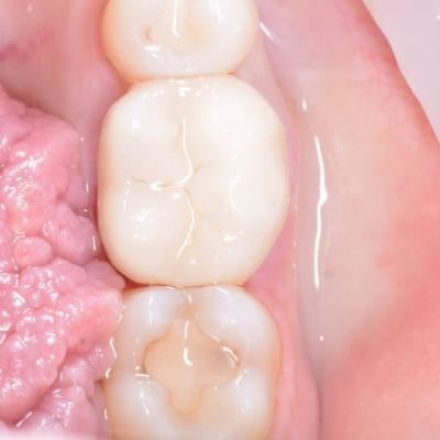 Protezuvannia Na Zubakh V10 I2