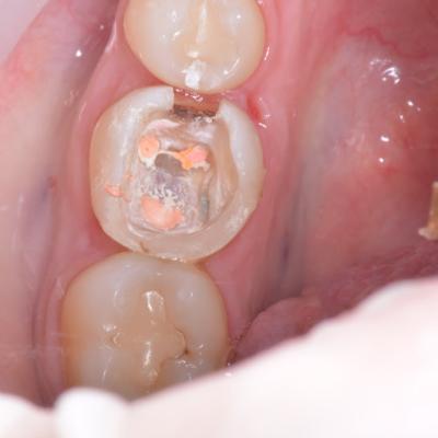 Protezuvannia Na Zubakh V11 I1