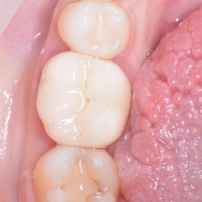 Protezuvannia Na Zubakh V11 I2