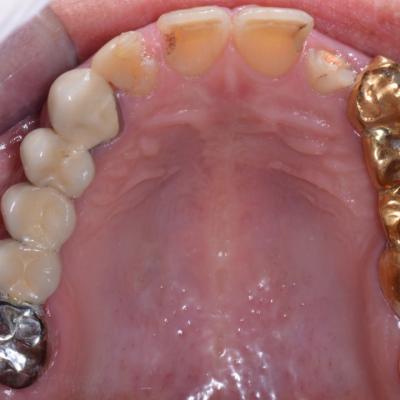 Protezuvannia Na Zubakh V12 I1