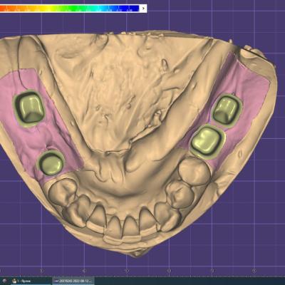 Protezuvannia Na Implantakh V16 I2