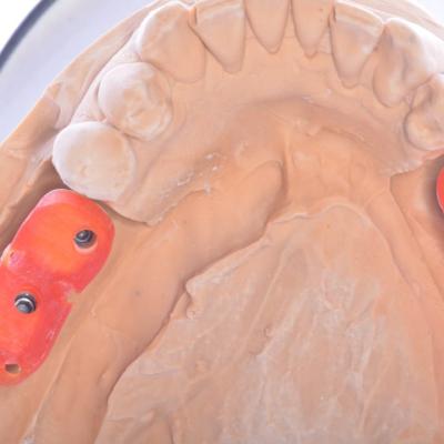 Protezuvannia Na Implantakh V16 I6