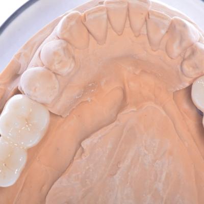 Protezuvannia Na Implantakh V16 I7