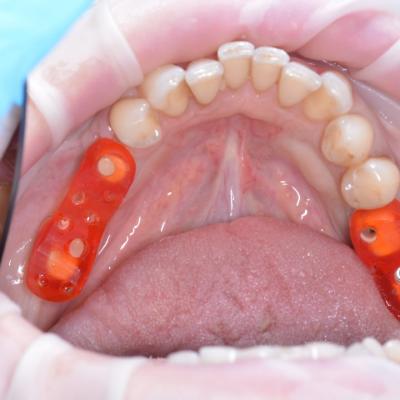 Protezuvannia Na Implantakh V16 I9