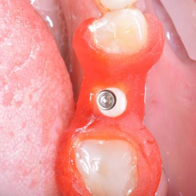 Protezuvannia Na Implantakh V17 I3