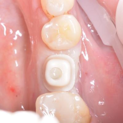 Protezuvannia Na Implantakh V17 I4