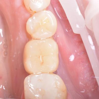 Protezuvannia Na Implantakh V17 I5